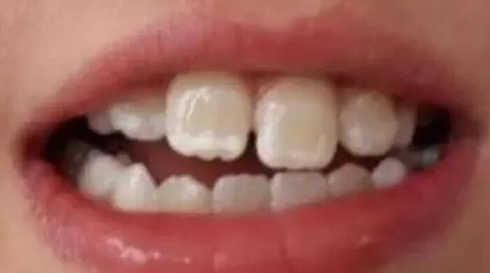 如果牙齿上出现小白点我们应该
